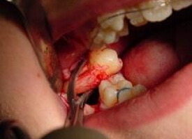 Wisdom tooth removal Price in Lahore